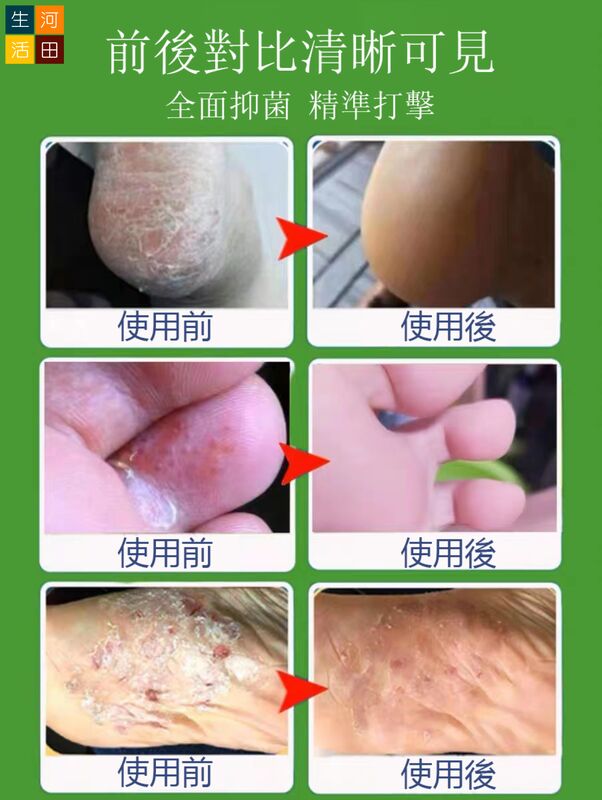 日本東京生物足部抑菌噴霧(30mL)|改善腳臭 防脫皮，足癬，爛腳跟 抑真菌 止腳汗除腳氣 腳部護理