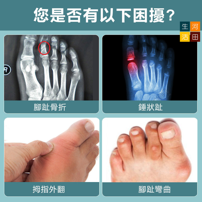 腳趾骨折鋁合金板條固定器(大腳趾款) | 拇指外翻矯正| 腳趾保護套|分趾器