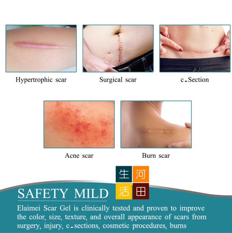 Elaimei 矽膠去疤修復貼(4cm x 1.5m)|肌膚疤痕修復貼|自粘性疤痕膠帶|剖腹產疤痕貼