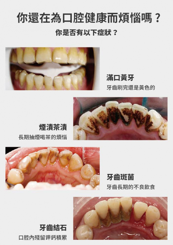 Maxcare 超聲波離子洗牙器