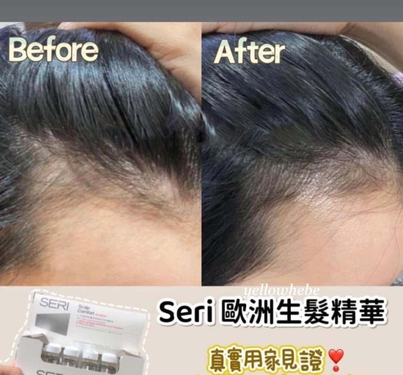 [正貨] 全城熱賣 - FARCOM SERI Scalp Comfort Advanced 專業防脫髮育髮精華 生髮精華 (10ml x 12支) 男女合用