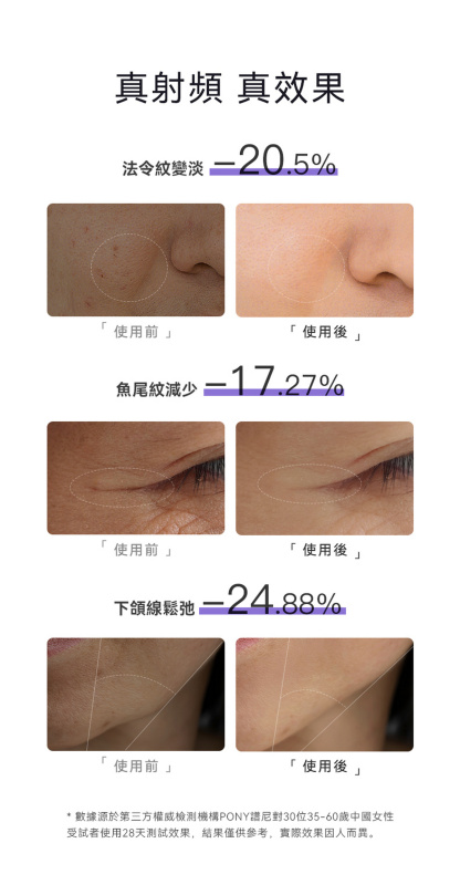 日本ANLAN - 晶鑽射頻美容儀 (紫色) ADRY14-10A｜射頻儀｜EMS微電流｜多功能美容儀｜導出儀｜LED光療機｜家用美容儀 【原裝行貨】【+送Kusa M