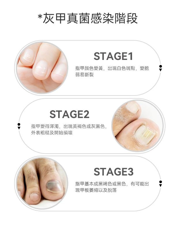 Rescover 7分鐘深層激光擊退灰甲夾式光療機