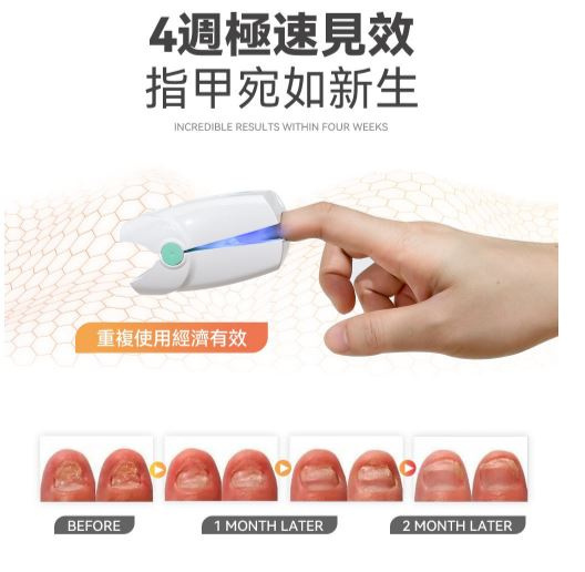 Rescover 7分鐘深層激光擊退灰甲夾式光療機