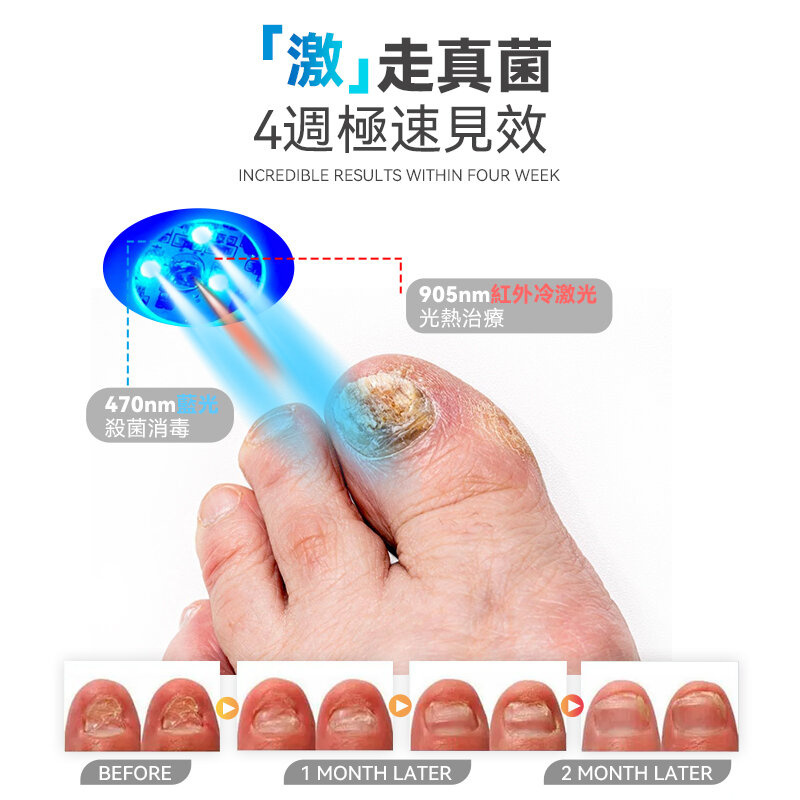 Rescover 7分鐘深層激光擊退灰甲夾式光療機