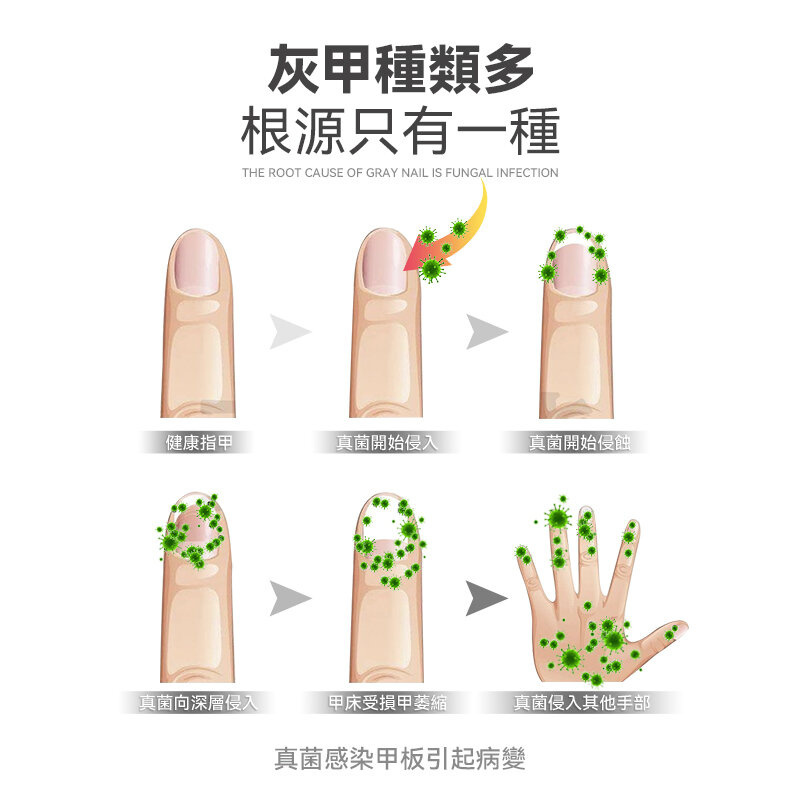 Rescover 7分鐘深層激光擊退灰甲夾式光療機