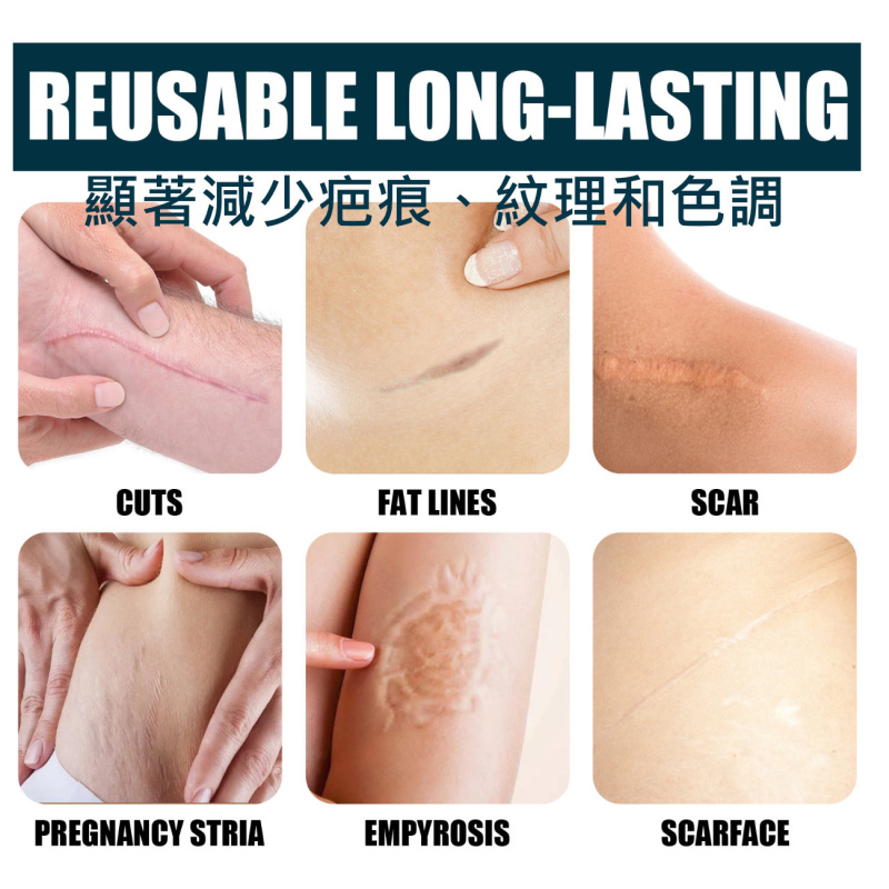 淡化傷疤平滑肌膚除疤膏|燙燒疤手術修護霜|產後产后妊娠纹凝膠|增生皮膚傷痕修复肌肤霜