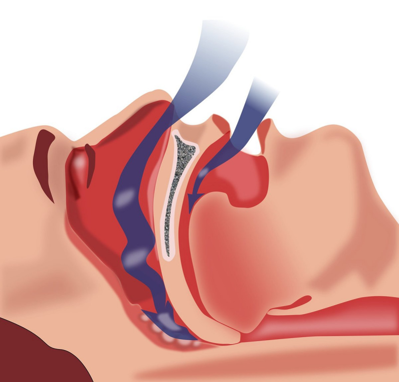 Snore Aid一套4個鼻腔擴張器-防止減低鼻鼾 BPA Free